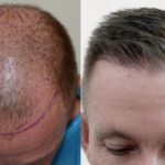 how much saw palmetto for hair loss