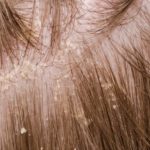 Dandruff vs. Dry Scalp: What's the Difference
