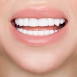 Living With Porcelain Dental Veneers: 8 Dos and Don’ts