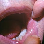 What is oral lichen planus