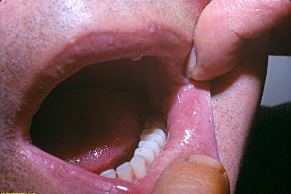 oral lichen planus