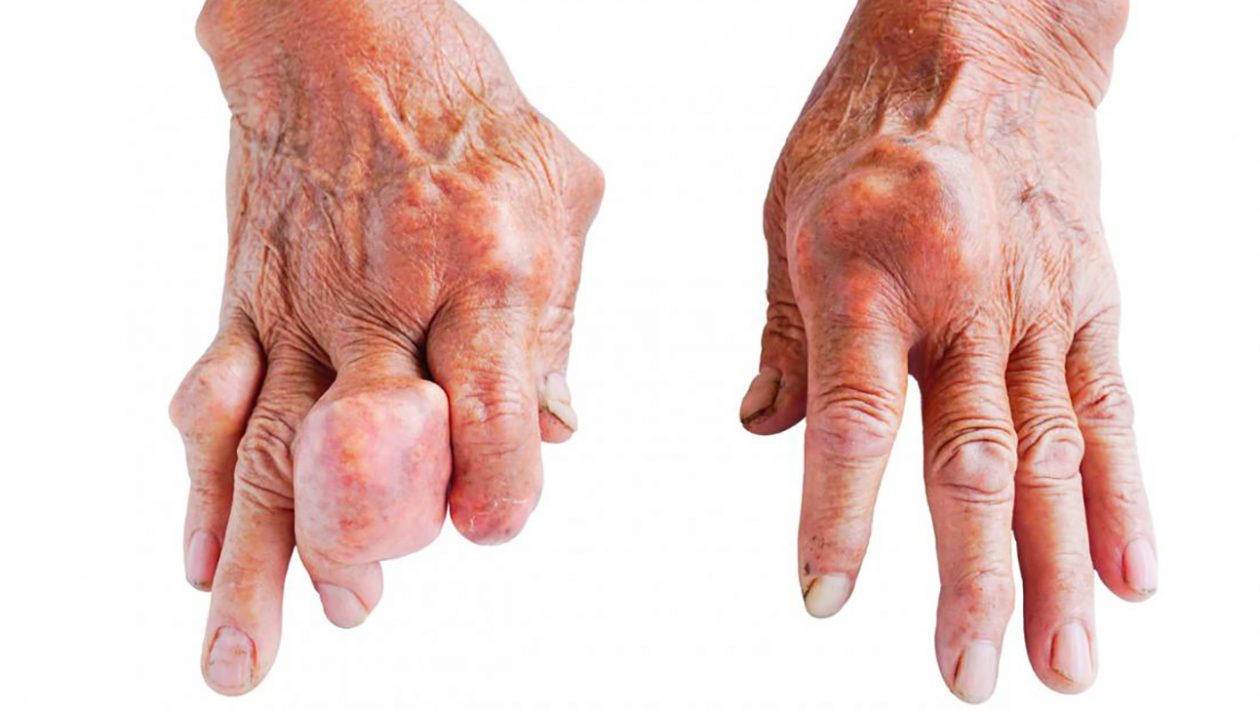 what is the main cause of gout