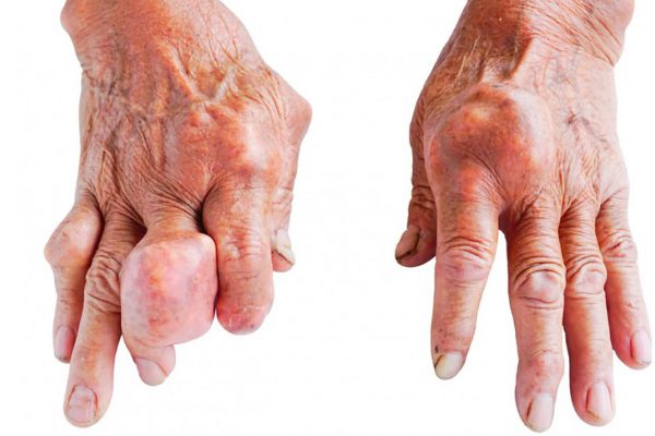 what is the main cause of gout