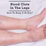 Blood clot in leg or Deep vein thrombosis symptoms, causes, and When to consult a doctor.