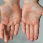 Hand foot and mouth rash – Causes and Treatments
