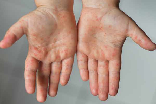 hand foot and mouth rash