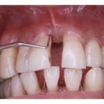 Reverse Periodontal Disease: Everything You Need To Know!