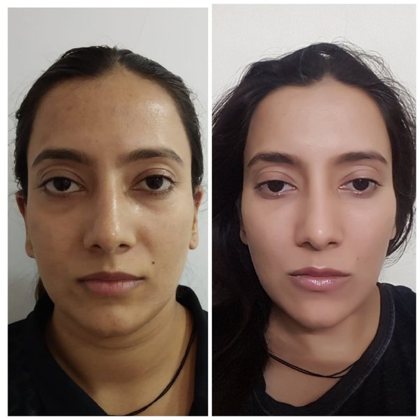 Celebrity Chin Filler Before and After
