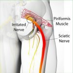 How to Heal Piriformis Syndrome Quickly Using Easy Steps!